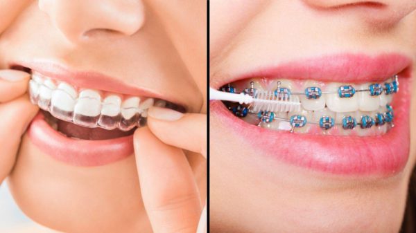 Clear Aligners vs. Braces: Which is More Affordable?